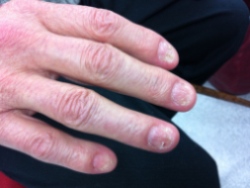 Nail changes in AL amyloidosis