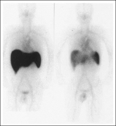 Whole body SAP scans demonstrating amyloid in the liver and spleen
